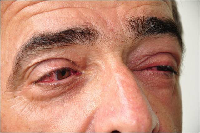 Conjuntivite, dor muscular e perda do paladar também são sintomas da Covid-19