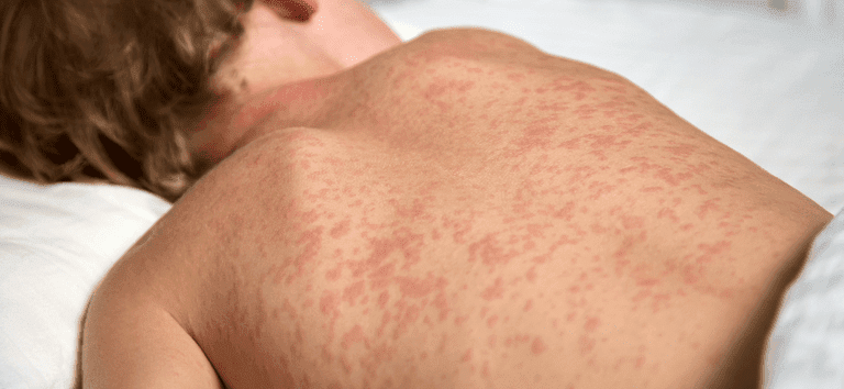 7 respostas para se proteger contra o sarampo, que volta a preocupar