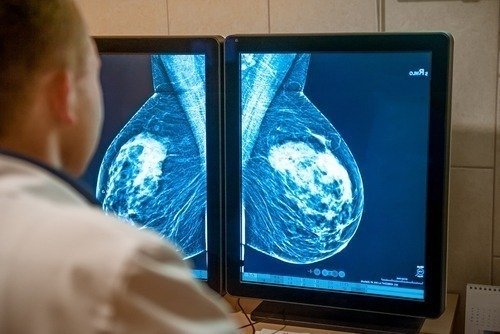 Por que (e como) os seios mudam após o tratamento do câncer de mama?