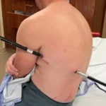 Homem anda 16 km com bastão cravado no corpo após queda