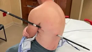 Homem anda 16 km com bastão cravado no corpo após queda