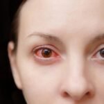 Conjuntivite: oftalmologista orienta sobre prevenção e quando buscar atendimento