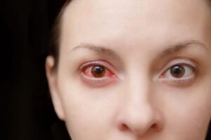 Conjuntivite: oftalmologista orienta sobre prevenção e quando buscar atendimento