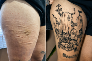 Projeto usa tatuagem para ressignificar cicatrizes e fortalecer autoestima em Alagoas